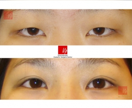 Sleepy eyes-Ptosis correction