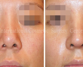 Remove foreign implant & autologous rhinoplasty