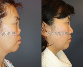 Revision rhinoplasty with Rib cartilage -Collapsed by silicone implant