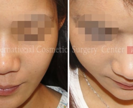 Harmony face surgery