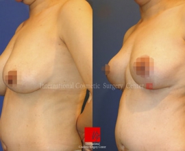 Breast lift