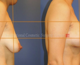 Breast lift & augmentation