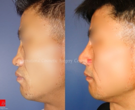 Flat nose correction with Rib cartilage (collapsed due to failure of s…