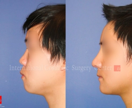 Rhinoplasty, Genioplasty