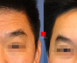 Forehead endoscope surgery-improvement of deep wrinkles