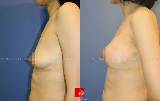 Tear drop breast augmentation