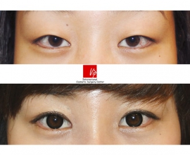 Ptosis correction