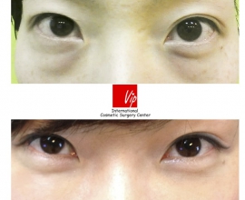 Lower Eyelid Fat Relocation