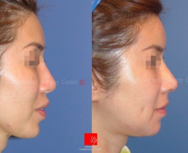 Revisional rhinoplasty using Rib carilage