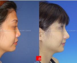 Asian nose with bulbous tip and wide alar – changed as higher and slim…