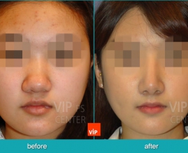 Bulbous nose – Harmony Rhinoplasty