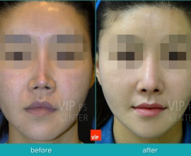 Rib Cartilage Rhinoplasty