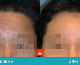 Forehead endscope lift