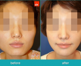 Septal Cartilage Rhinoplasty, Face Contouring Surgery, V-line Surgery,…