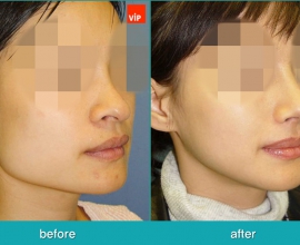 Rhinoplasty and Deviated Septum Surgery, Face Contouring Surgery, Jawl…