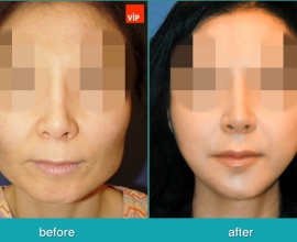 Face Contouring Surgery, V-line Jaw Reduction, Fat Graft, Cheekbone Re…