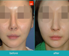 Rib cartilage Rhinoplasty