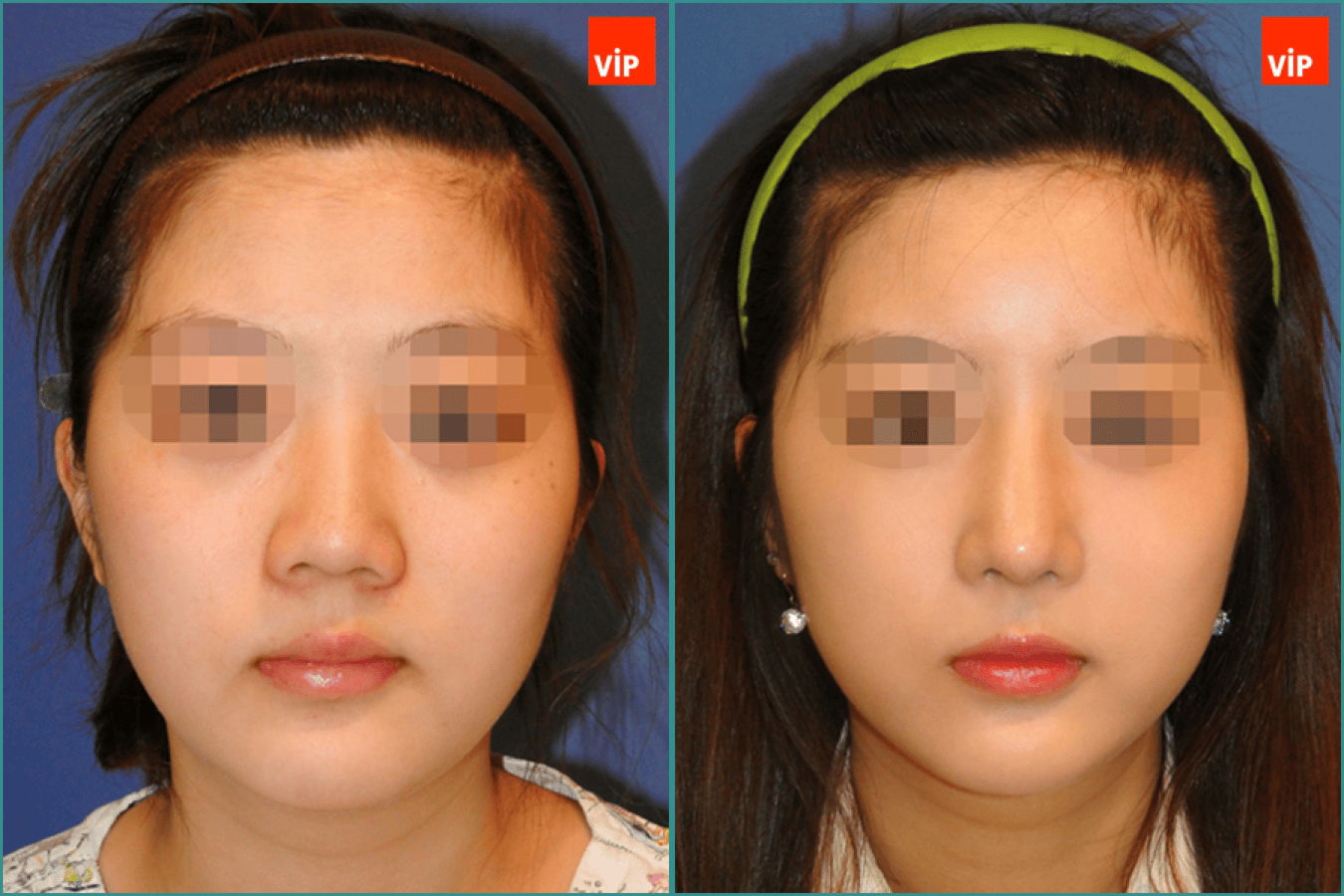 septal deviation rhinoplasty 1