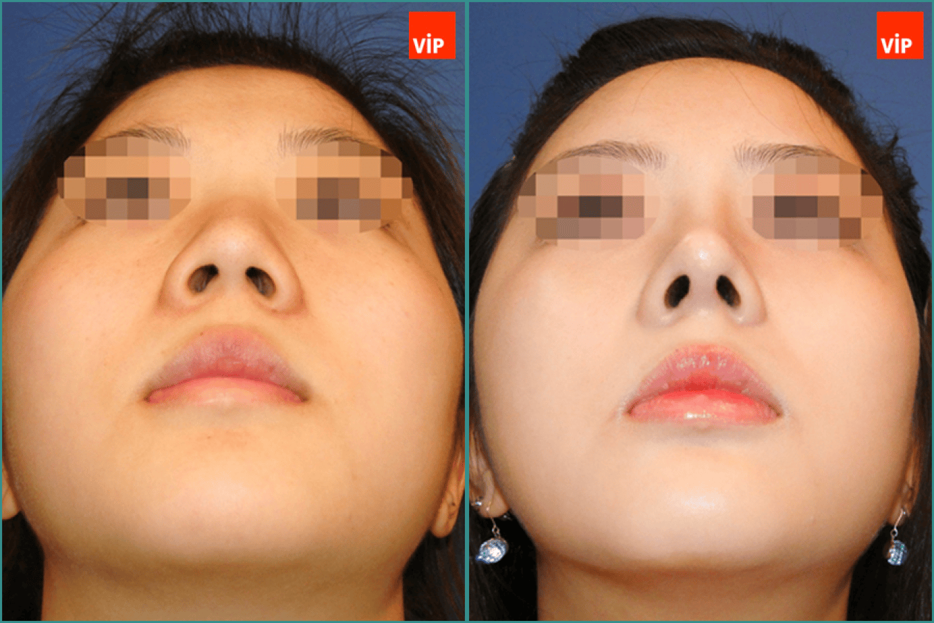 septal deviation rhinoplasty