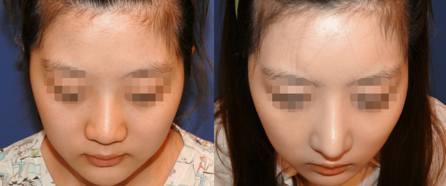 septal deviation rhinoplasty