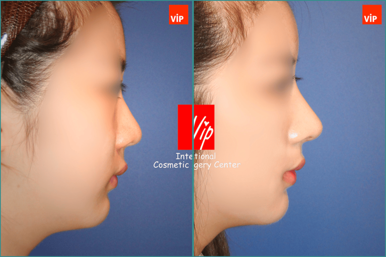 septal deviation rhinoplasty