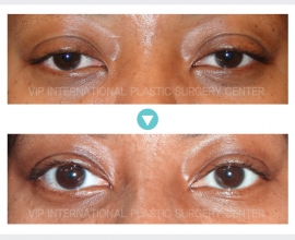 Ptosis Correction