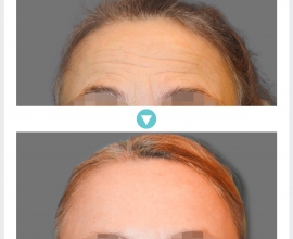 Endoscopic Forehead Lift