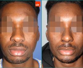 Rib cartilage rhinoplasty, Forehead endoscopic lift, Genioplasty