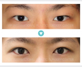 Male Ptosis Correction