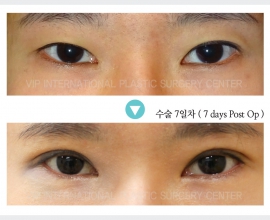 Eyelid surgery