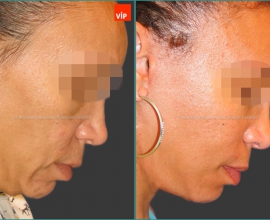 Facelift, Necklift