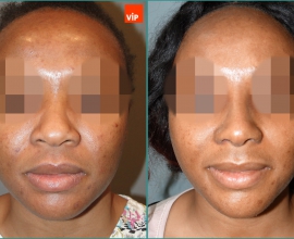 Rib cartilage rhinoplasty, Mid face augmentation, Ethnic Rhinoplasty