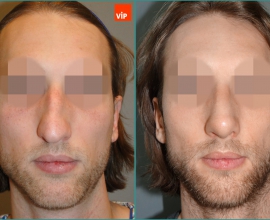 Septal cartilage rhinoplasty, Hump Nose