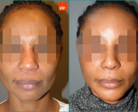 Rib cartilage rhinoplasty