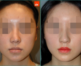 Rib cartilage rhinoplasty