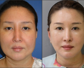 Facelift, Combination Rhinoplasty, Eyelid Surgery