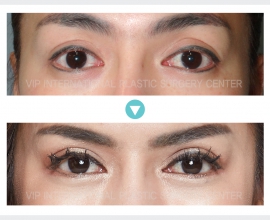 Ptosis Correction