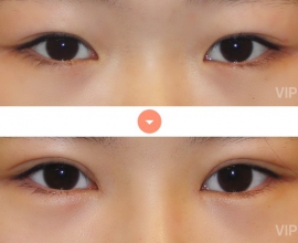 Double Eyelid Surgery