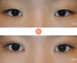 Double Eyelid Surgery