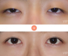 Double Eyelid Surgery