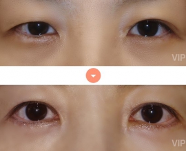 Double Eyelid Surgery