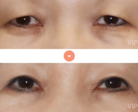 Double Eyelid Surgery