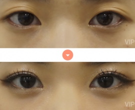 Double Eyelid Surgery