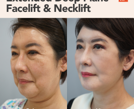 Extended Deep Plane Facelift & Necklift