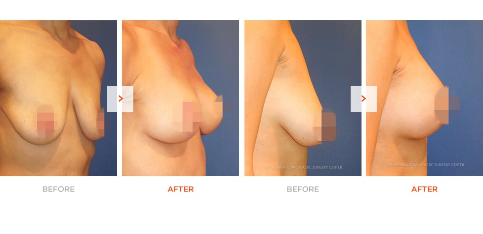 Breast Lift Surgery Before and After