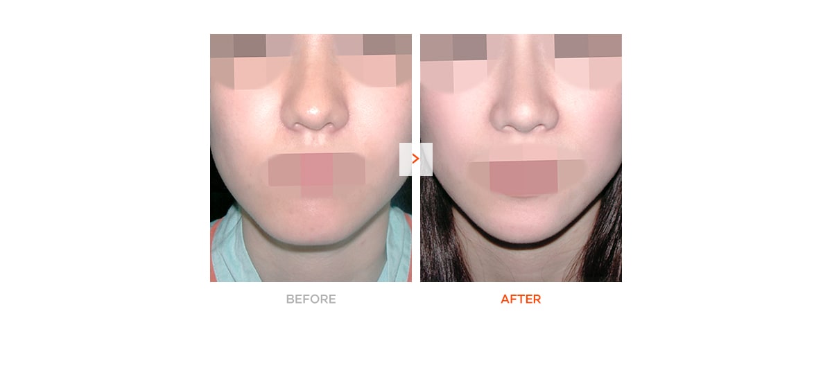 Chin Surgery – Before and After