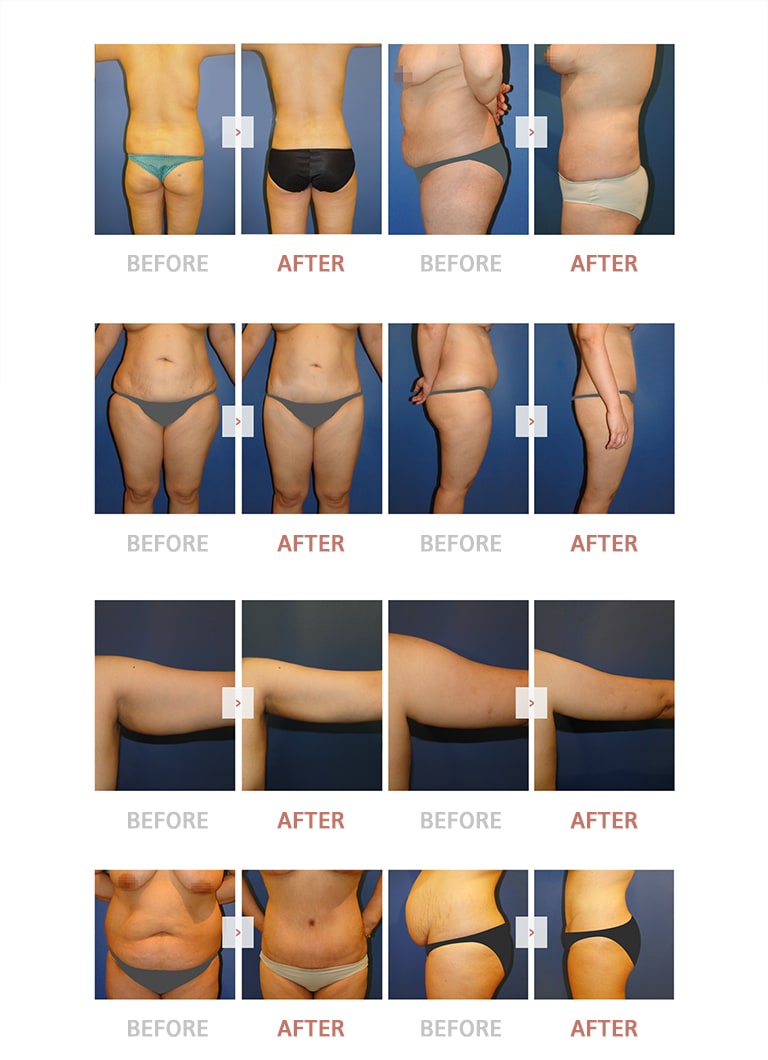 Liposuction Before and After