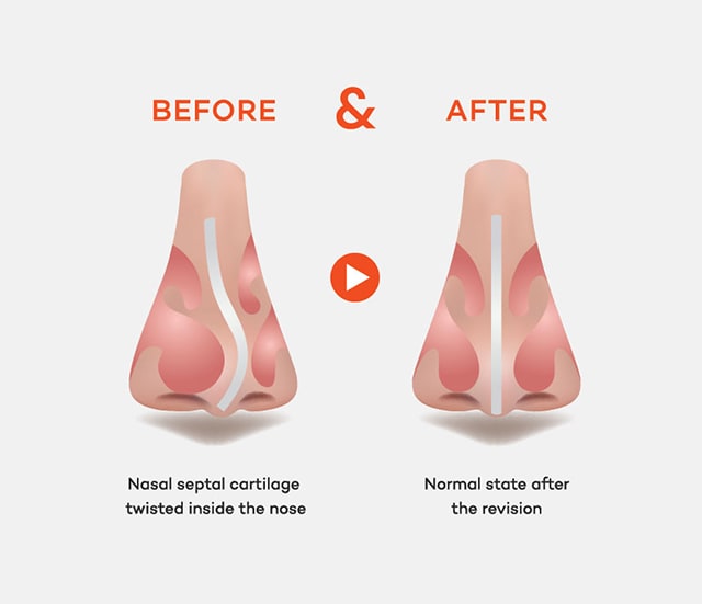 Revision Rhinoplasty of Nasal Septal Cartilage deviation case