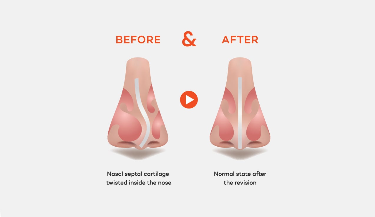 Revision Rhinoplasty of Nasal Septal Cartilage deviation case