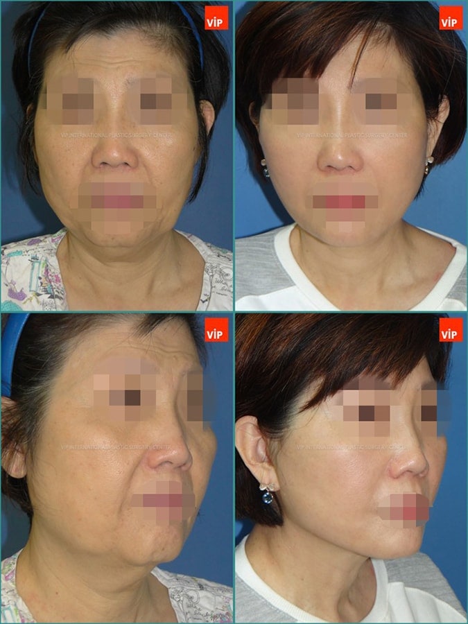 Anti aging surgeries -Case Study